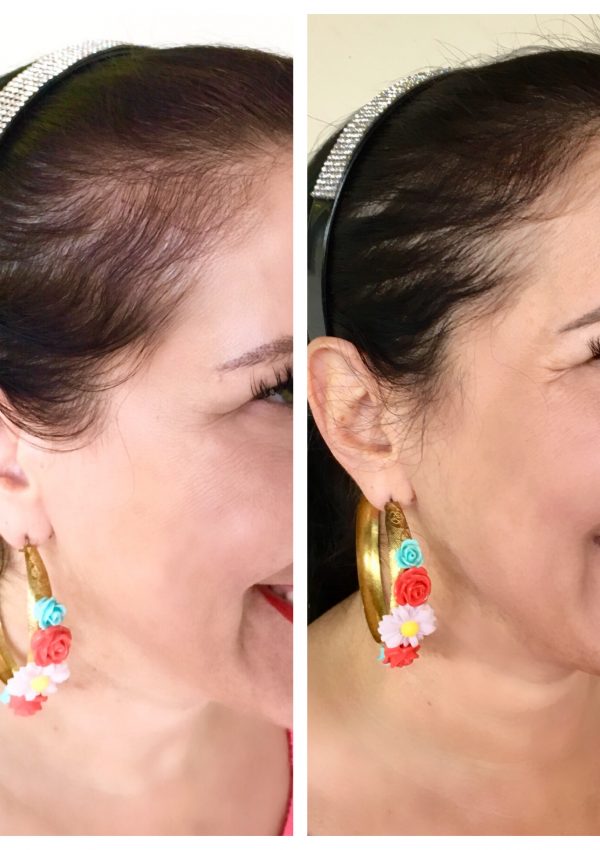 I recently tried the iRestore Laser Hair Growth System to treat my thinning hair. After three months of using this system, I am thrilled with the noticeable & transformative results.
