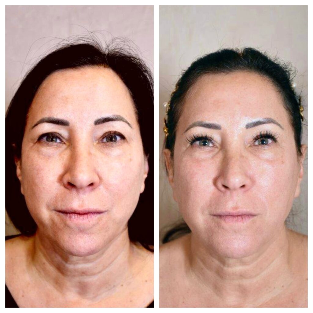 Potenza Microneedling Before and after photos of a woman.